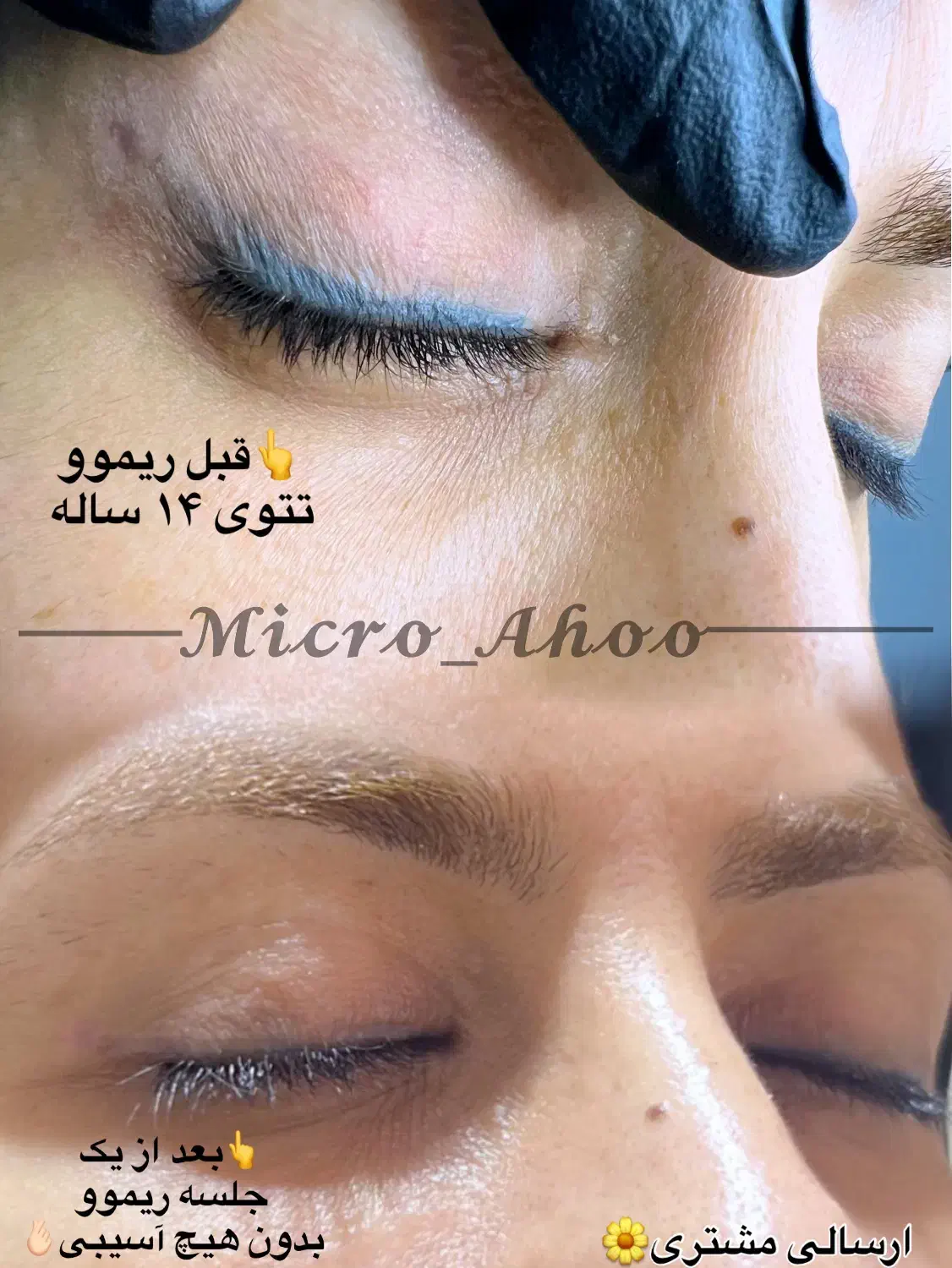 دیگه نگران تکرار زیاد جلسات پاک شدن تتوت نباش|خدمات آرایشگری و زیبایی|بندر گناوه, |دیوار