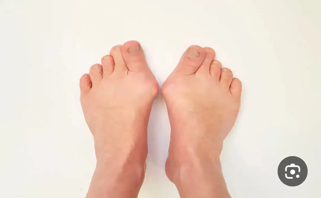 کلینیک درمان هالوکس والگوس (شصت پای کج)|خدمات آرایشگری و زیبایی|بهار, |دیوار