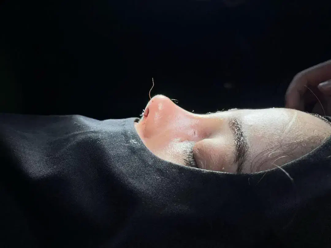 جراحی و عمل زیبایی بینی ( رینو پلاستی )|خدمات آرایشگری و زیبایی|کرج, گوهردشت|دیوار