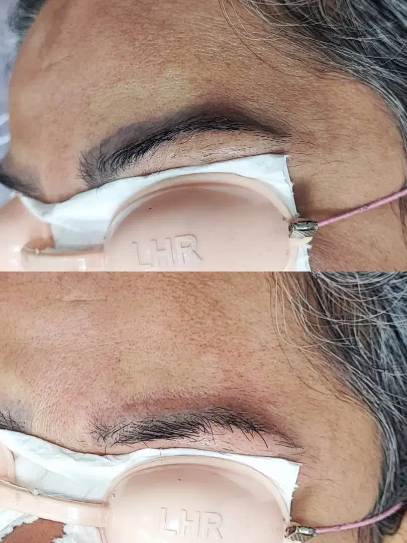 ریموو تتو و رفع تیرگی بدن در مطب پزشک|خدمات آرایشگری و زیبایی|آبادان, |دیوار