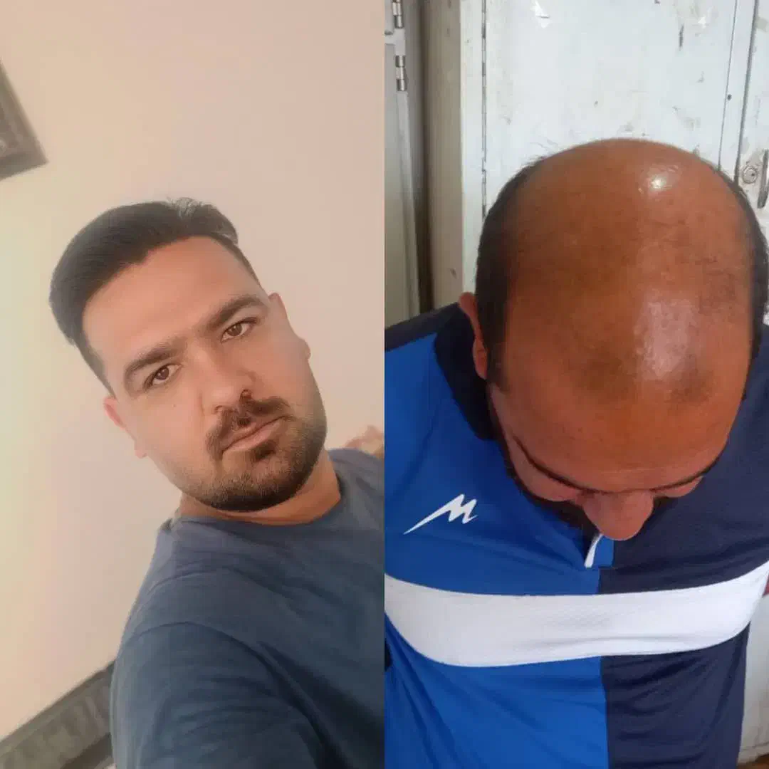 کاشت مو به روش شیرازی|خدمات آرایشگری و زیبایی|قم, زنبیل آباد|دیوار