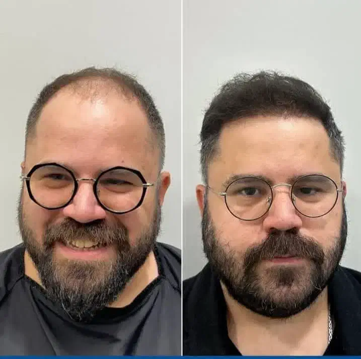 جشنواره پاییزه کاشت مو و کاشت ابرو|خدمات آرایشگری و زیبایی|تهران, دردشت|دیوار