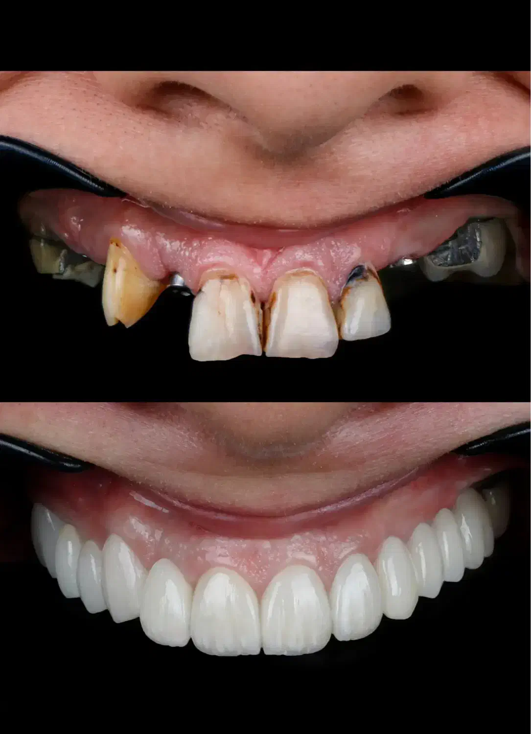 ایمپلنت فوری فقط۱۰۳۰۰/دندانپزشکی با اقساط۶-۱۵ماهه|خدمات آرایشگری و زیبایی|ملکان, |دیوار