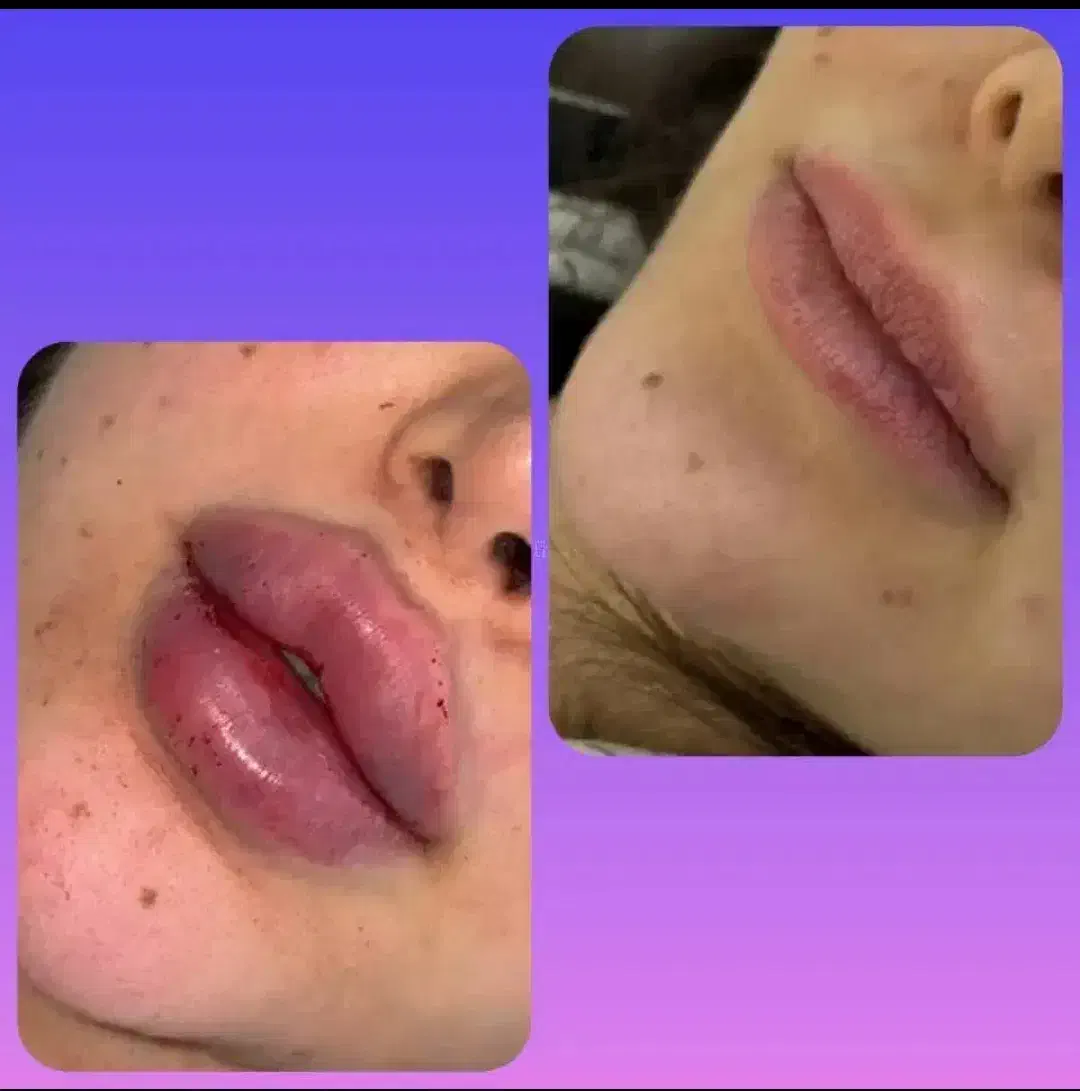 تزریق ژل و بوتاکس با مواد اصل و اورجینال|خدمات آرایشگری و زیبایی|ساری, |دیوار