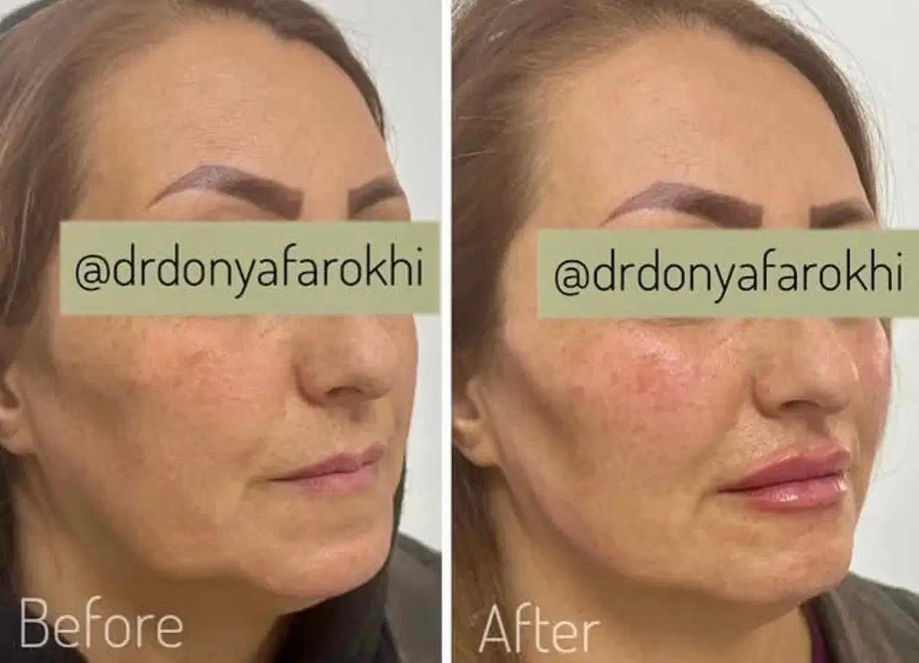 ژل بوتاکس لیزر لاغری مشاوره رایگان مطب دکتر فرخی|خدمات آرایشگری و زیبایی|اسلامآباد غرب, |دیوار