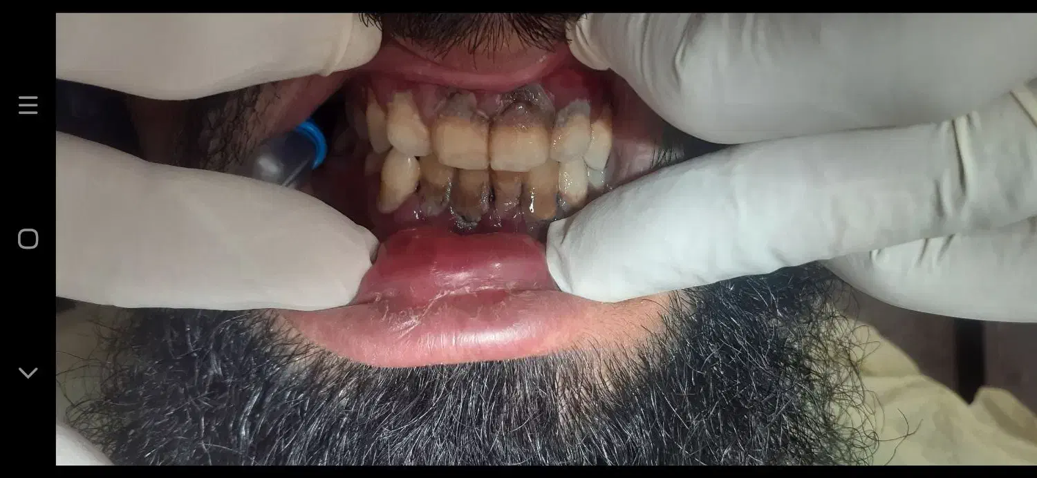 انجام جرمگیری هر فک فقط ۴۵۰ تومان در مطب شخصی|خدمات آرایشگری و زیبایی|زاهدان, |دیوار