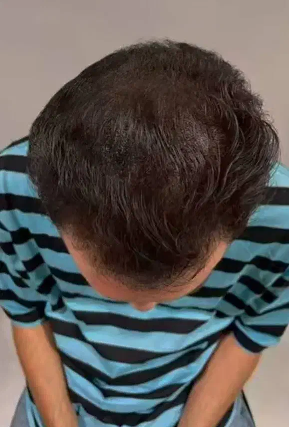 درمان قطعی ریزش مو و رد مجدد مو با پکیج درمانی H3|خدمات آرایشگری و زیبایی|شاهین‌شهر, خانه کارگر|دیوار