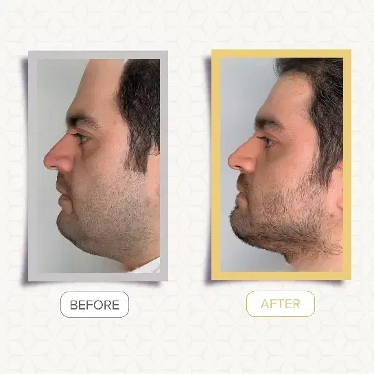 ساکشن غبغب|خدمات آرایشگری و زیبایی|رشت, گلسار|دیوار