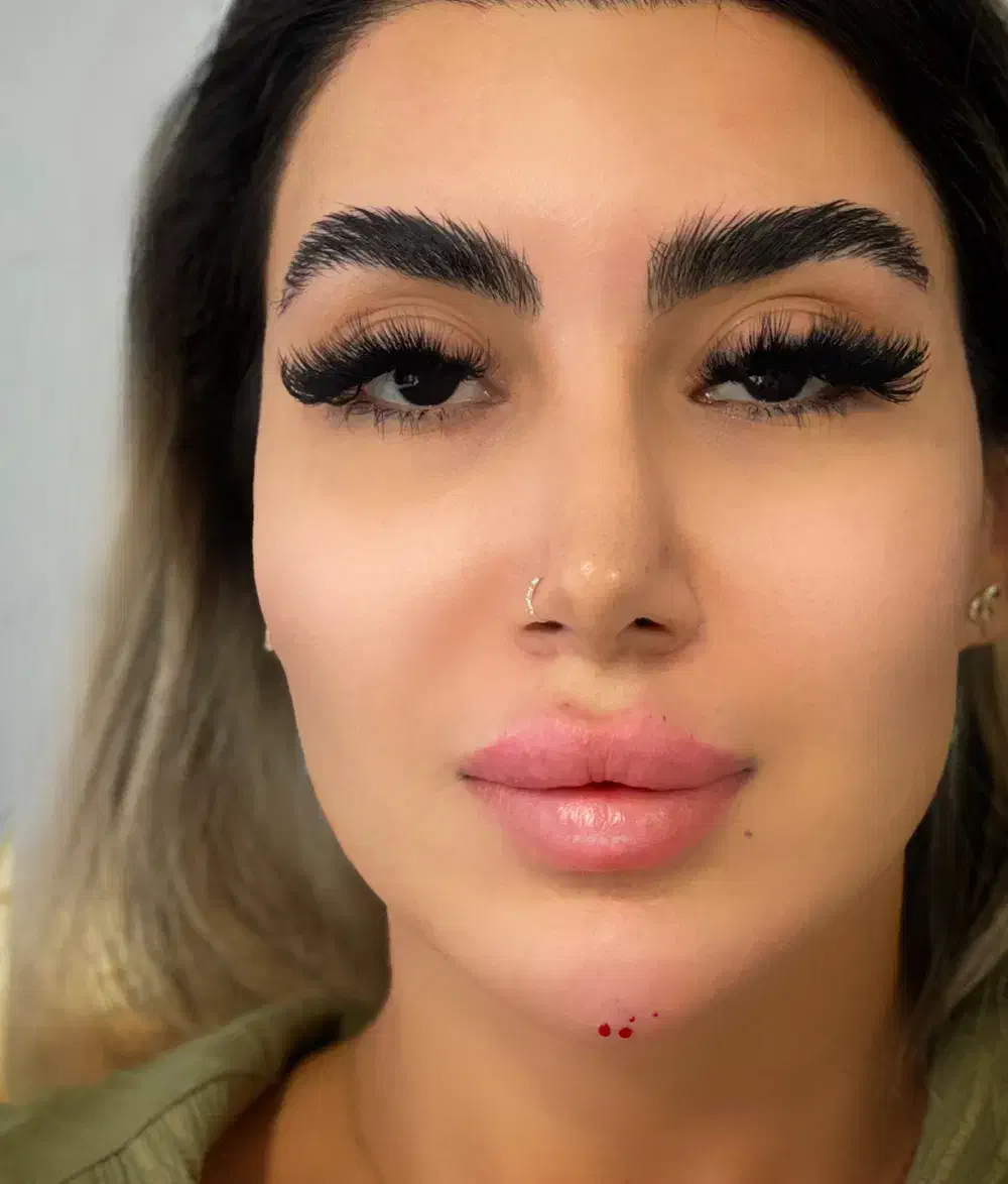 بوتاکس فیلرژل لب گونه چانه زاویه فک و صورت مادلینگ|خدمات آرایشگری و زیبایی|تهران, تهرانپارس غربی|دیوار