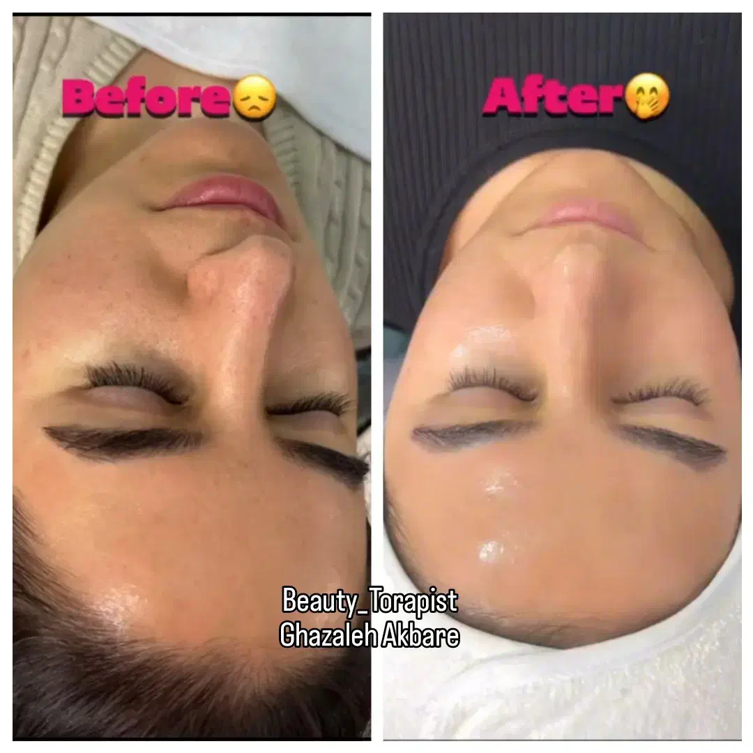 پاکسازی و جوانسازی پوست . هایفو صورت و غبغب|خدمات آرایشگری و زیبایی|مشهد, سجاد شهر|دیوار