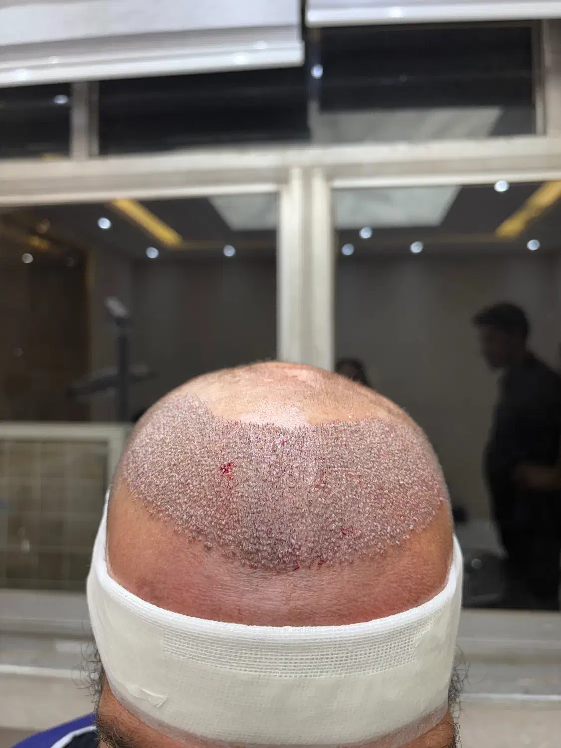 کاشت مو فول تراکم حتی بانک موی ضعیف|خدمات آرایشگری و زیبایی|تبریز, |دیوار