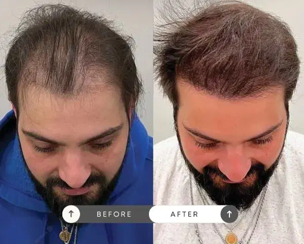 خواهان مدل برای prp مو و صورت|خدمات آرایشگری و زیبایی|سنندج, |دیوار