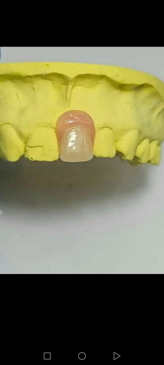 دندانسازی ساخت دندان مصنوعی متحرک باضمانت|آرایشی، بهداشتی، درمانی|مشکیندشت, |دیوار