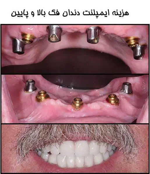 کاشت دندان بدون پیش پرداخت و اقساط بلند مدت|خدمات آرایشگری و زیبایی|یاسوج, |دیوار