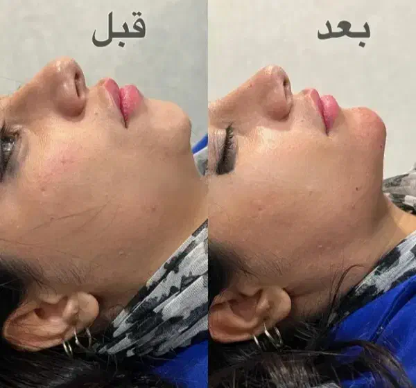 جشنواره پاییزه زیبایی ژل بوتاکس لیزر مزو|خدمات آرایشگری و زیبایی|رشت, نامجو|دیوار