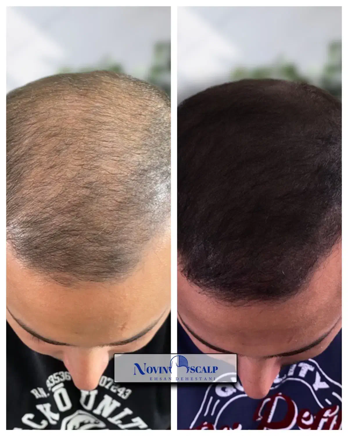 رفع کم پشتی مو با میکرو اسکالپ/ جایگزین کاشت مو|خدمات آرایشگری و زیبایی|مشهد, وکیلآباد|دیوار