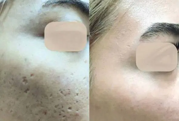 درمان تخصصی در یک جلسه اسکار آکنه و جای جوش|خدمات زیبایی و سلامت|کرمانشاه, |دیوار