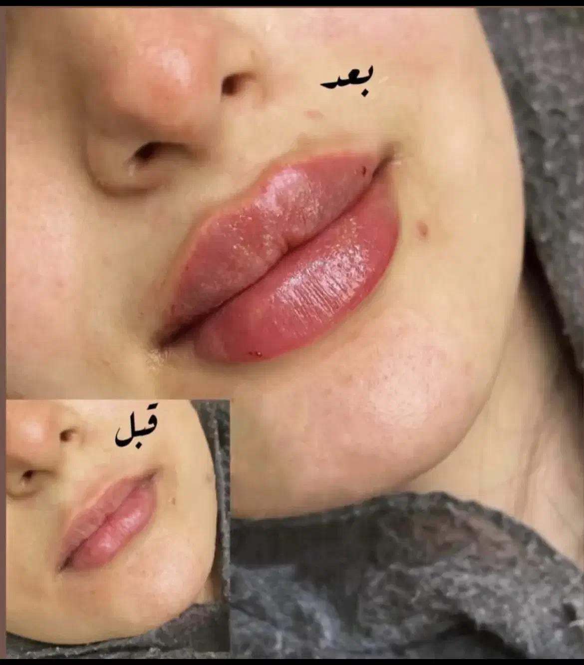 تزریق تخصصی ژل و بوتاکس|خدمات آرایشگری و زیبایی|سبزوار, کوی بهار|دیوار