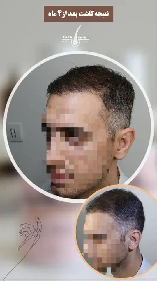 کاشت مو و کاشت اَبرو|خدمات آرایشگری و زیبایی|فسا, |دیوار