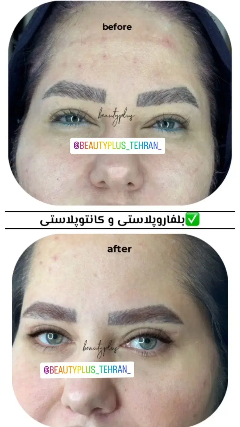بلفاروپلاستی بخیه لیزری و با بیحسی کامل درمطب پزشک|خدمات آرایشگری و زیبایی|قم, زنبیل آباد|دیوار