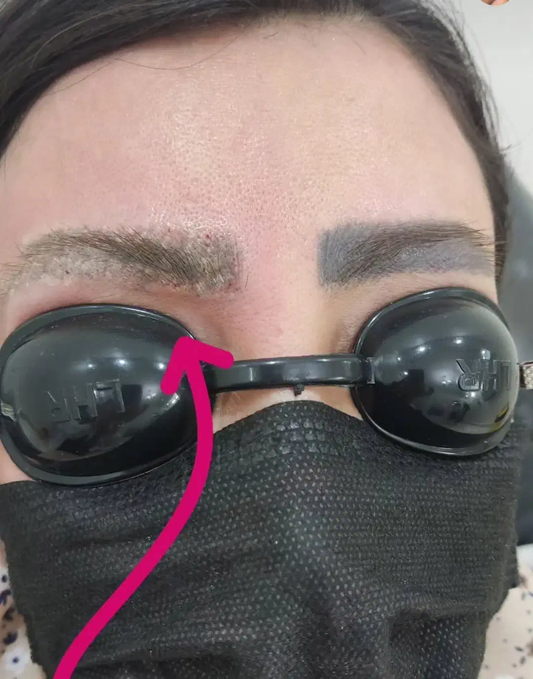 جشنواره لیزر ریمو تتو ابرو وبدن در مطب پزشک|خدمات آرایشگری و زیبایی|قم, بلوار امین و ساحلی|دیوار