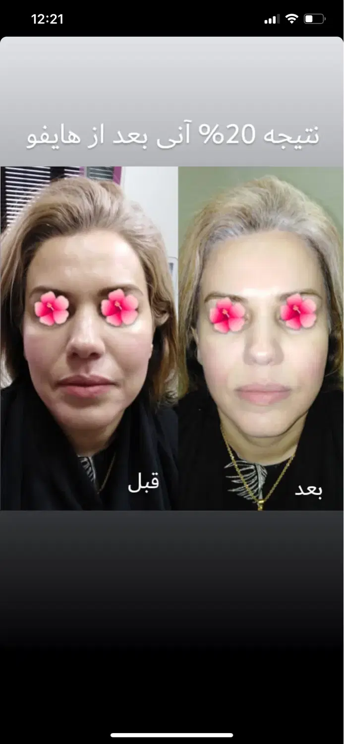 تزریق ژل و بوتاکس جشنواره|خدمات زیبایی و سلامت|تهران, عبدلآباد|دیوار