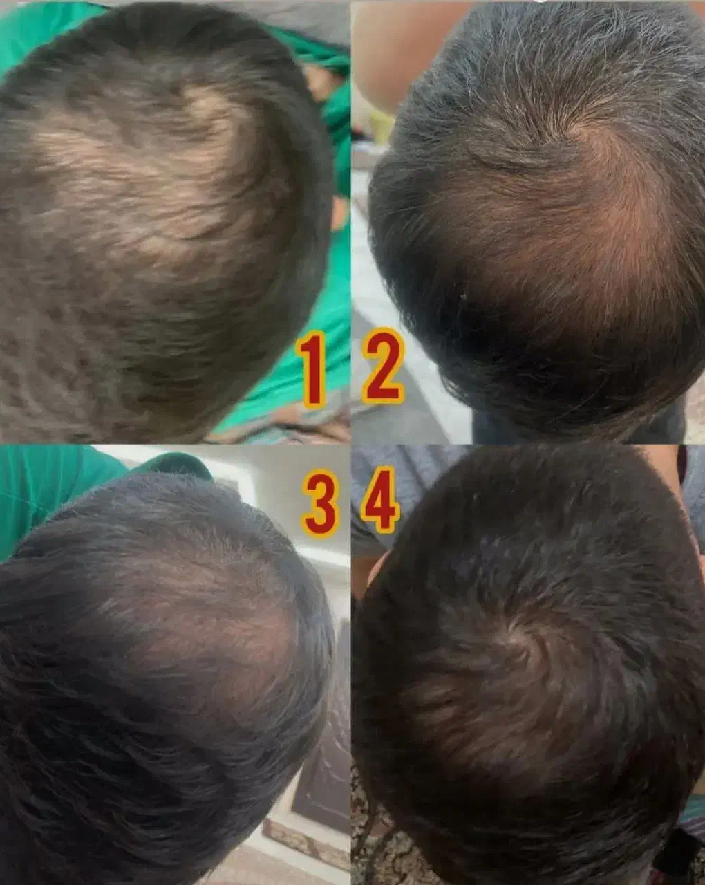 معجزه قرن/رشد ۳ برابری مو|آرایشی، بهداشتی، درمانی|خوشاب, |دیوار