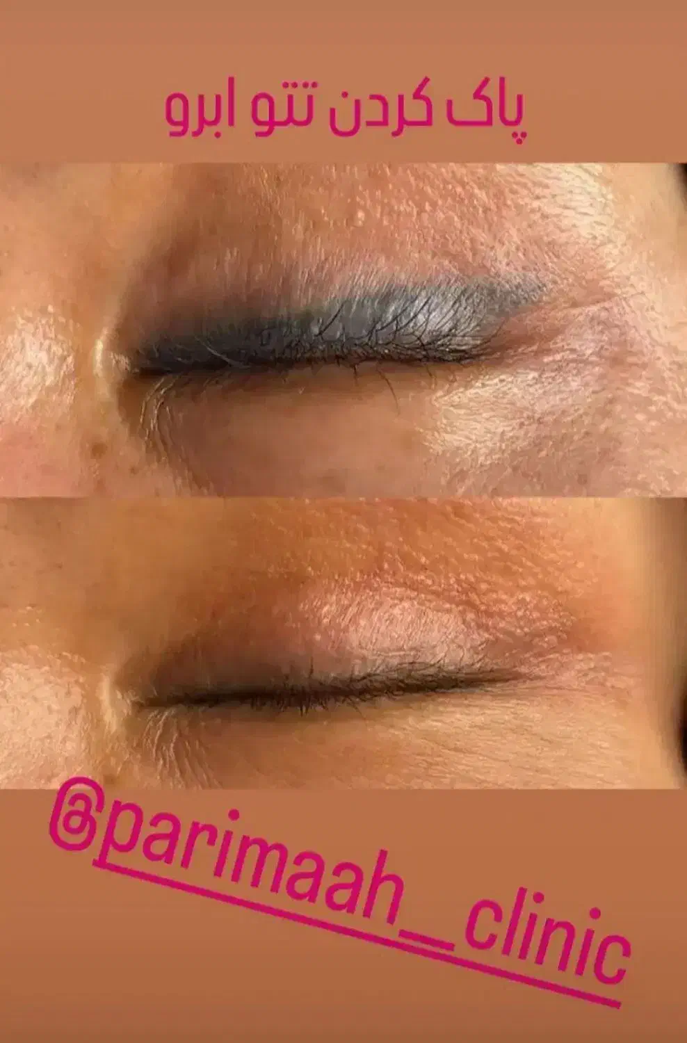 پاک کردن انواع تتو و خالکوبی بالیزر تخصصی کیوسویچ|خدمات آرایشگری و زیبایی|فولادشهر, پارک کوهستان|دیوار