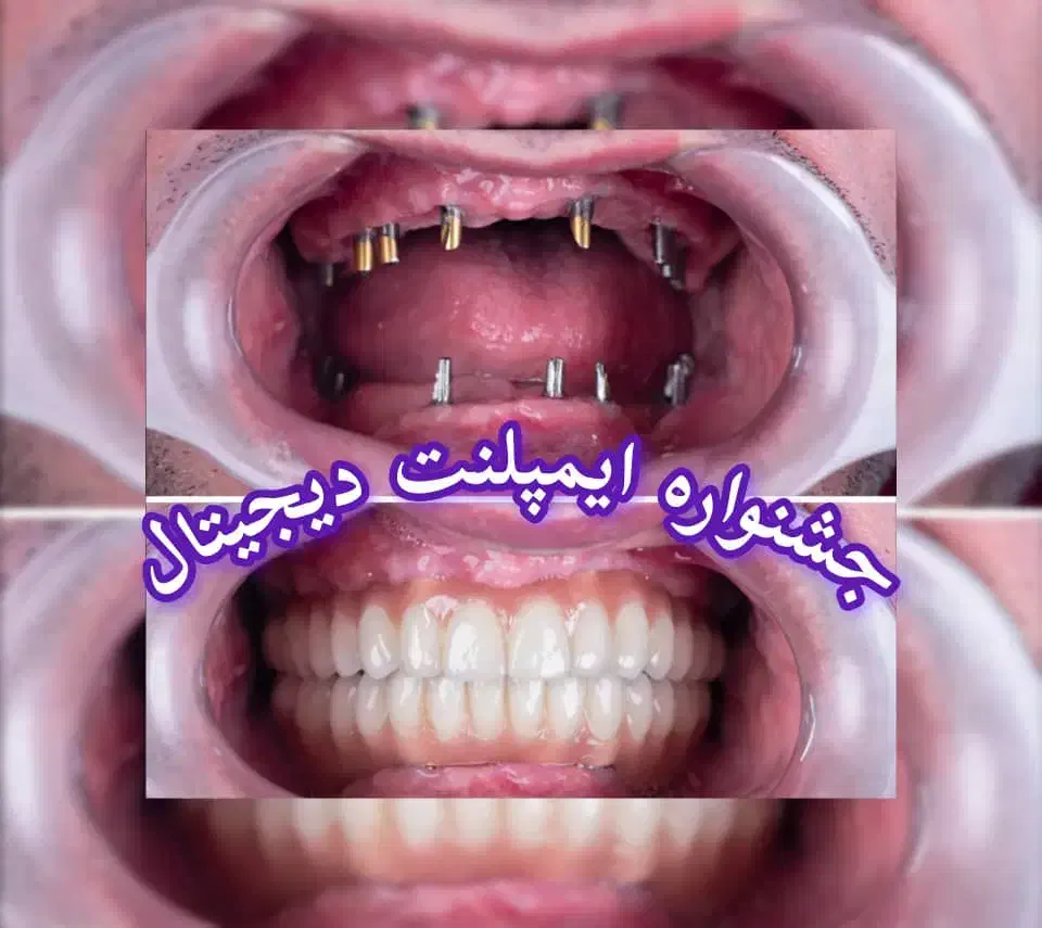 3 واحد ایمپلنت1واحد رایگان/جشنواره ایمپلنت دیجیتال|خدمات آرایشگری و زیبایی|تهران, هروی|دیوار