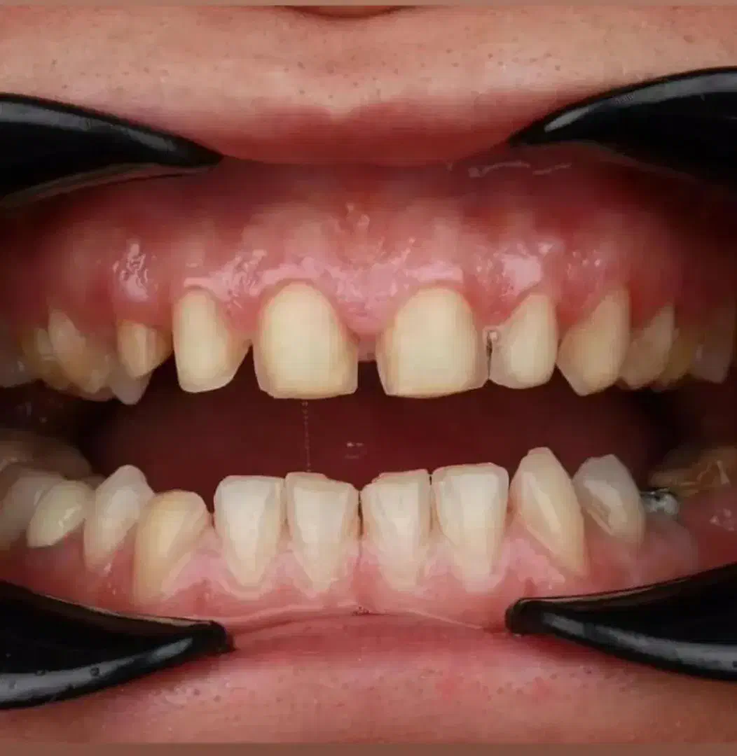 کامپوزیت دندان روکش لمینت با قیمت مناسب و اقساط|خدمات آرایشگری و زیبایی|ری, شهرری|دیوار