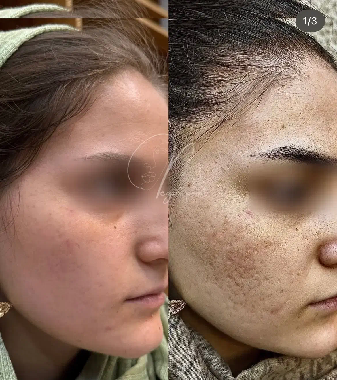 مدل جهت کار درمان تلفیقی پوست|خدمات آرایشگری و زیبایی|چالوس, |دیوار