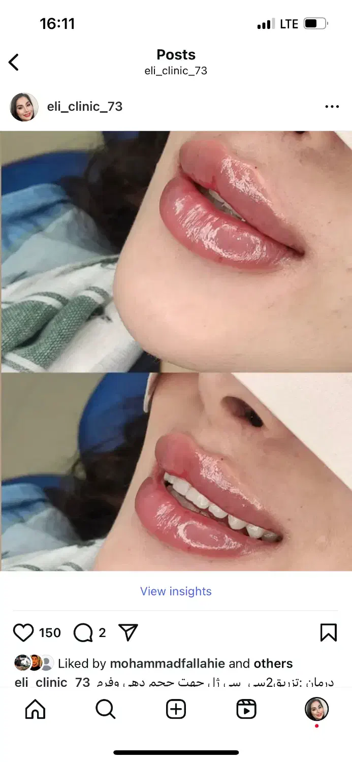 تزریق ژل و بوتاکس|خدمات آرایشگری و زیبایی|بروجرد, |دیوار