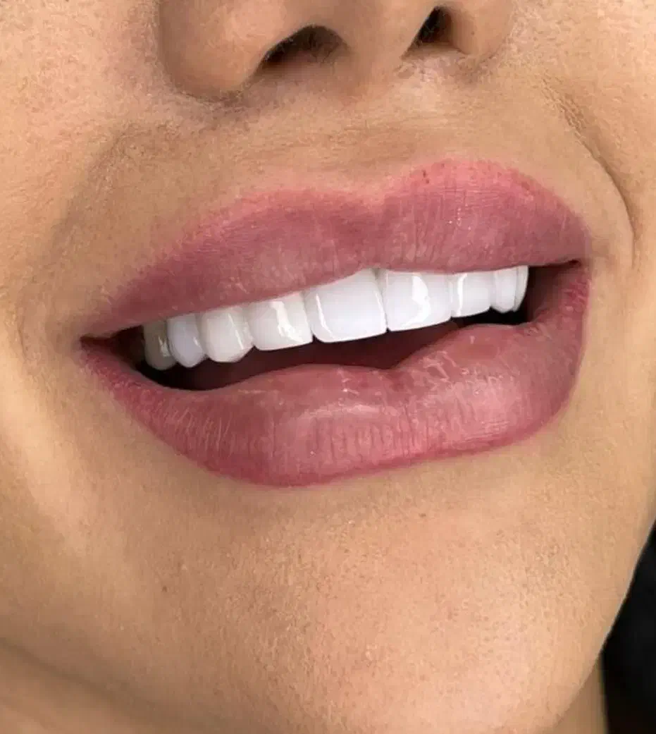 ترمیم عصب کشی روکش کامپوزیت زیبایی|خدمات آرایشگری و زیبایی|اردبیل, |دیوار