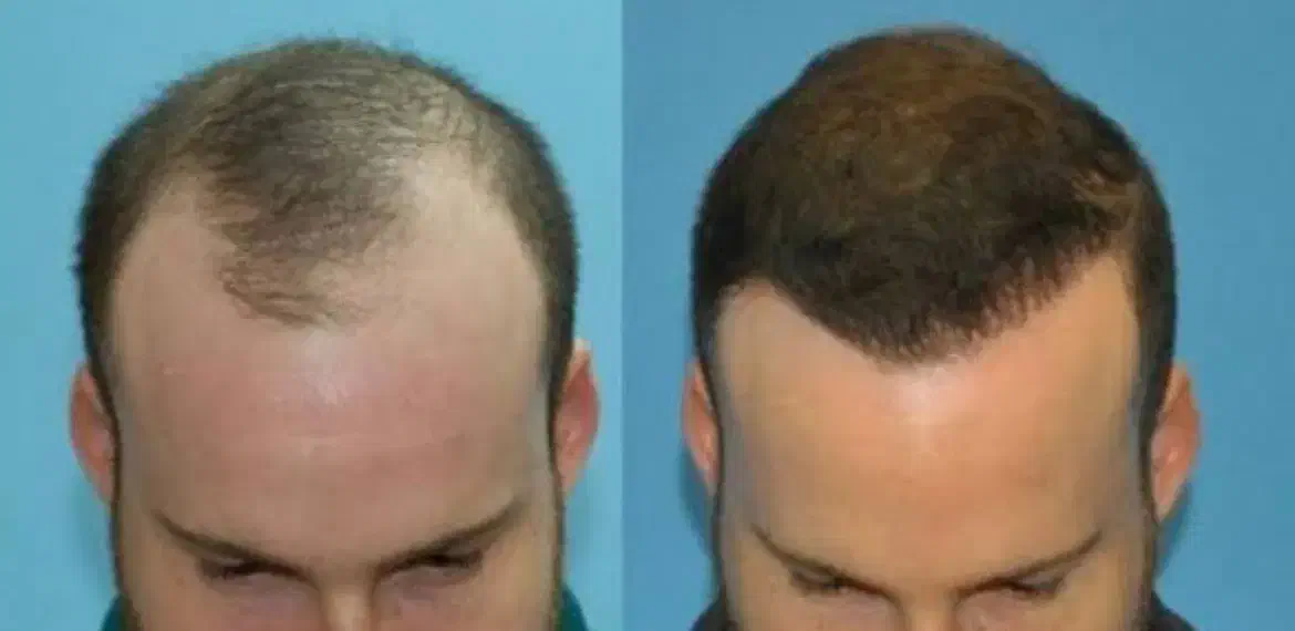 کاشت مو تراکم بالا|خدمات آرایشگری و زیبایی|کرمان, |دیوار