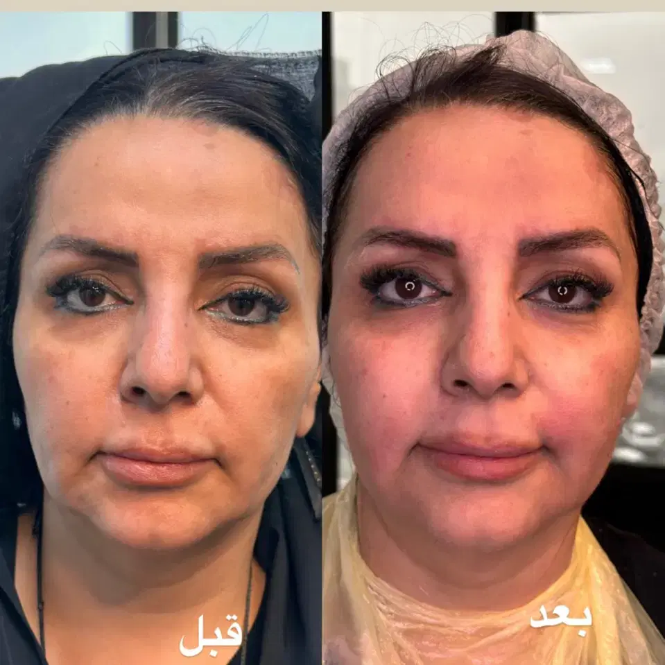 تخفیف تزریق ژل و بوتاکس ویژه|خدمات زیبایی و سلامت|تهران, شکوفه (عبدل آباد)|دیوار