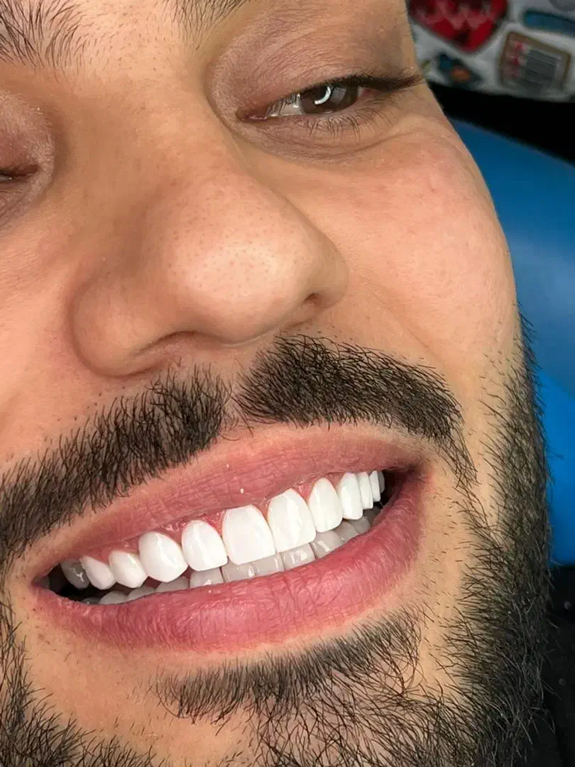 کامپوزیت دندان جشنواره لمینت ایمکس|خدمات آرایشگری و زیبایی|تهران, شمس‌آباد|دیوار