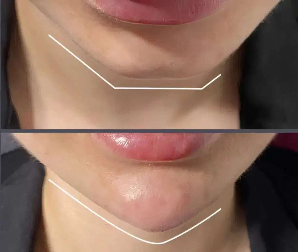 تخصص حرفه ای تزریق لب روسی|خدمات آرایشگری و زیبایی|ارومیه, |دیوار