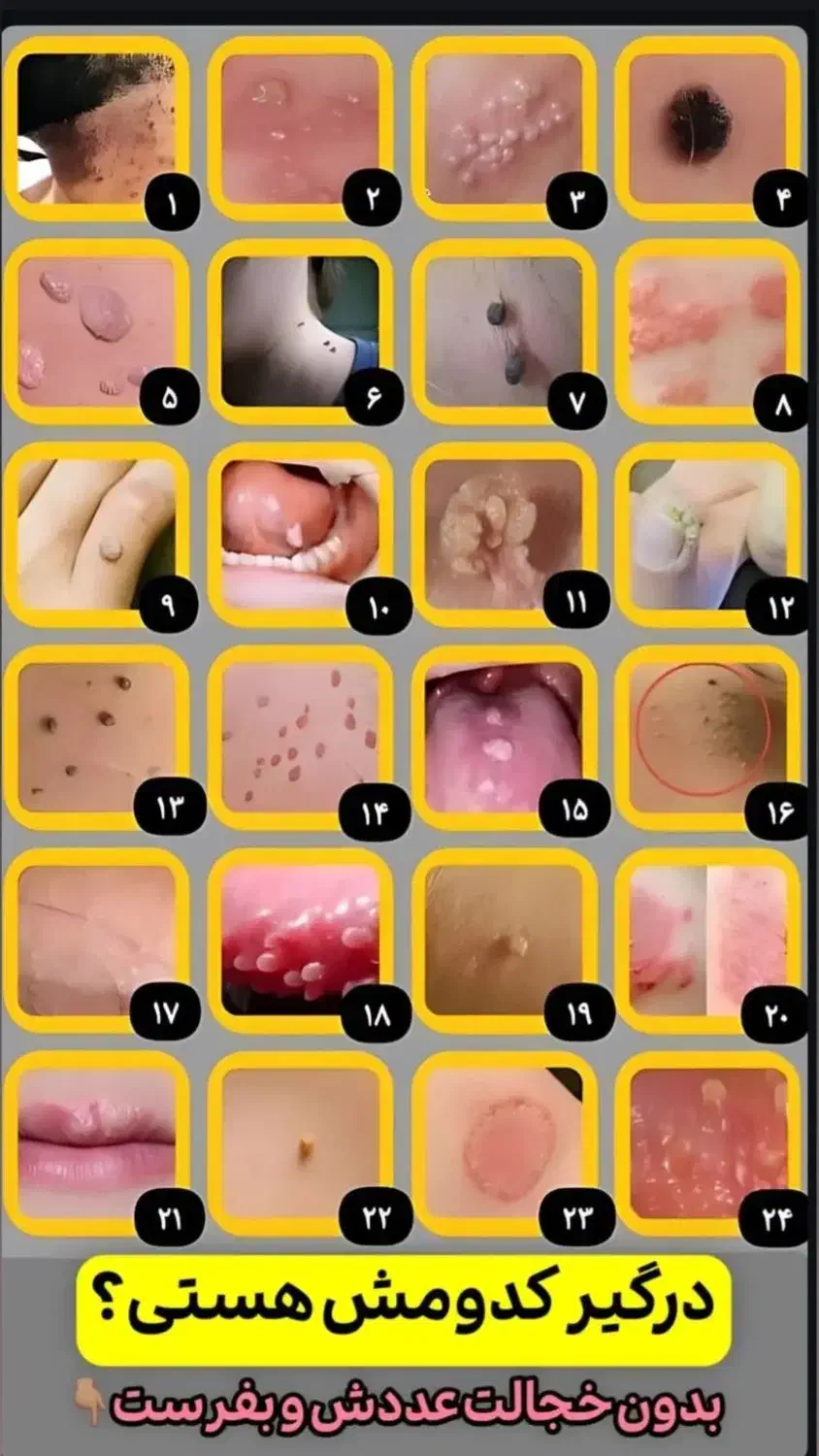 درمان قطعی زگیل و تبخال تناسلی|آرایشی، بهداشتی، درمانی|بندرعباس, |دیوار