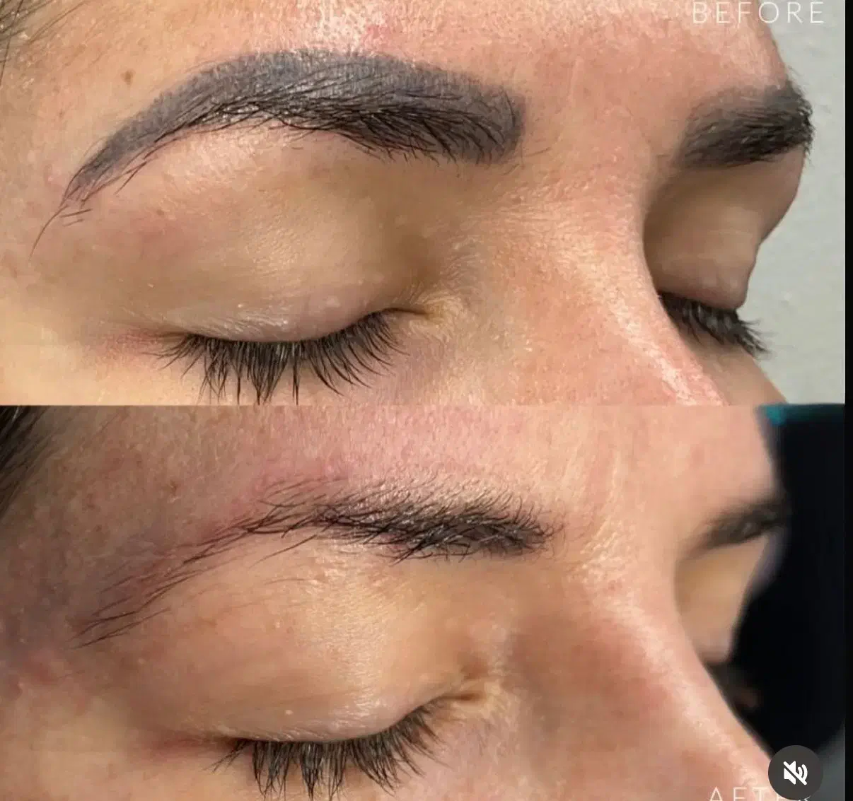 ریموو تاتو صورت و بدن با لیزر کیوسوییچ امریکایی|خدمات آرایشگری و زیبایی|گرگان, |دیوار