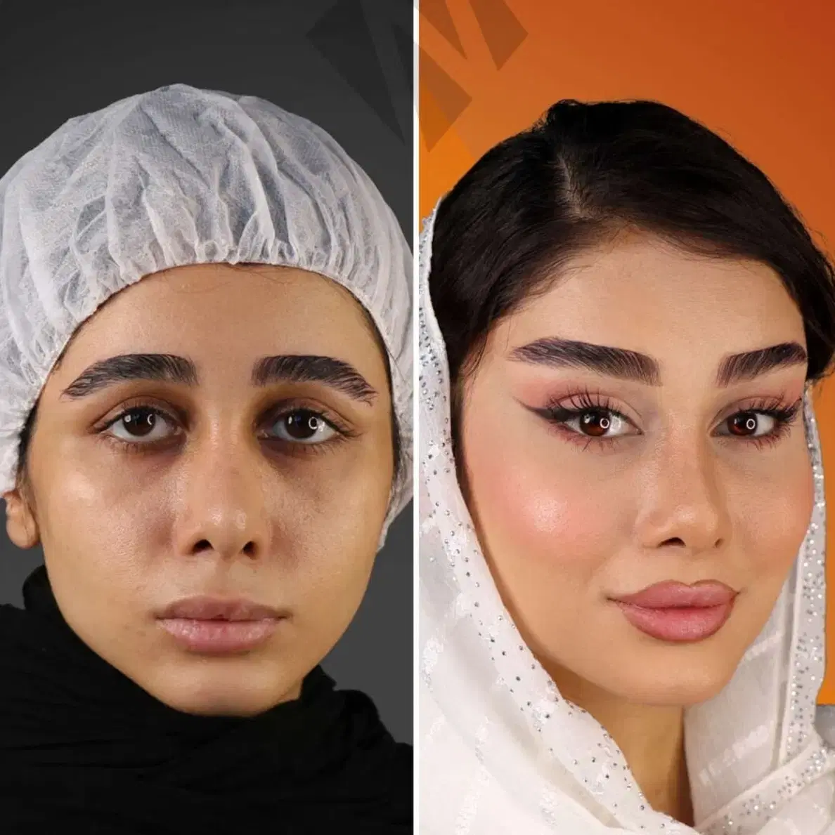 آف۵۰٪پکیج ابرو FOX EYE پزشک پلک غبغب ژل بینی شقیقه|خدمات زیبایی و سلامت|مشهد, هنرستان|دیوار