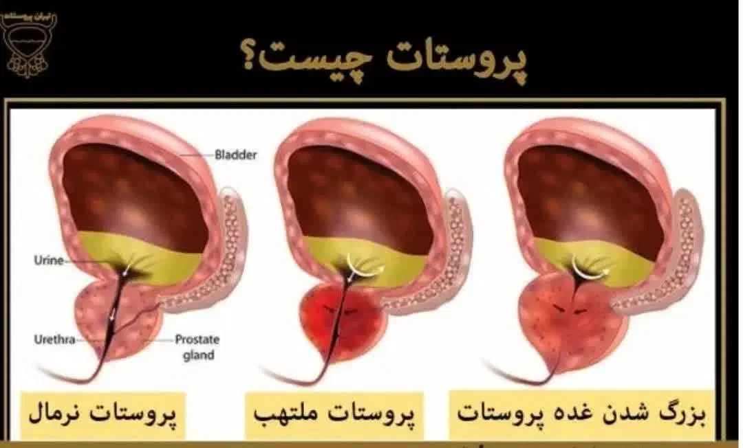 و درمان بیماری پروستا ت|خدمات آرایشگری و زیبایی|قم, میدان نو|دیوار