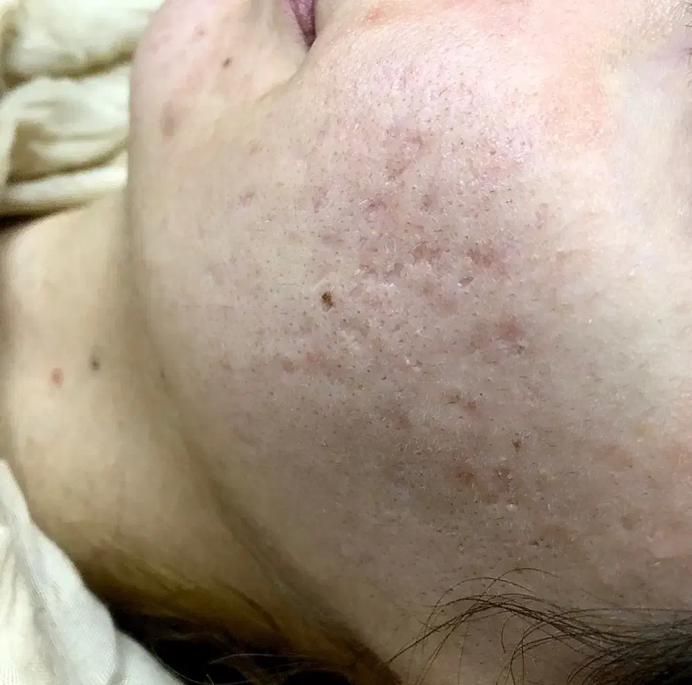 سابسیژن بافت اسکار|خدمات آرایشگری و زیبایی|ایلام, |دیوار