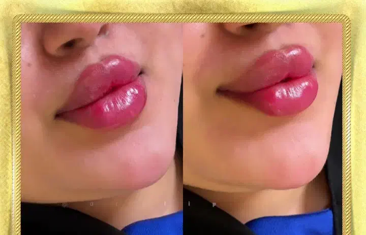 ساکش غبغب تزریق .باسن.شکم|خدمات آرایشگری و زیبایی|کرمانشاه, |دیوار