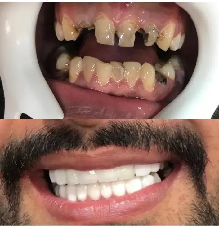 عصب کشی دندان روکش کامپوزیت دندانپزشکی متخصص شهرک|خدمات زیبایی و سلامت|تهران, تهرانسر مرکزی|دیوار