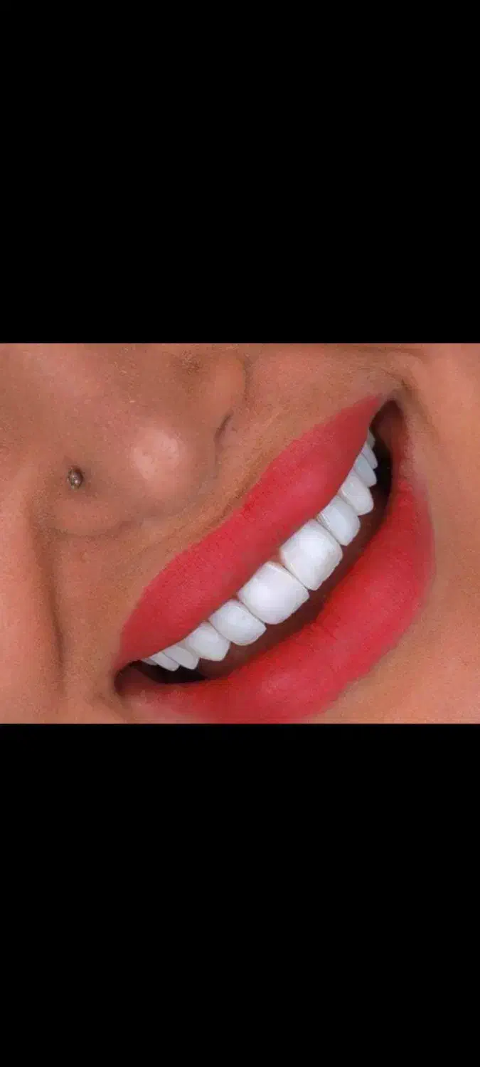 کامپوزیت دندان|خدمات آرایشگری و زیبایی|آبادان, |دیوار