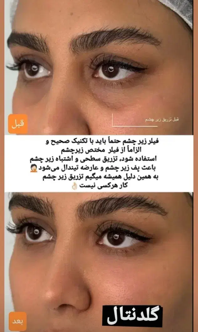 فیلر ژل لب بوتاکس تخصصی پزشک کلینیک تهرانسر|خدمات آرایشگری و زیبایی|اسلام‌شهر, باغ فیض|دیوار