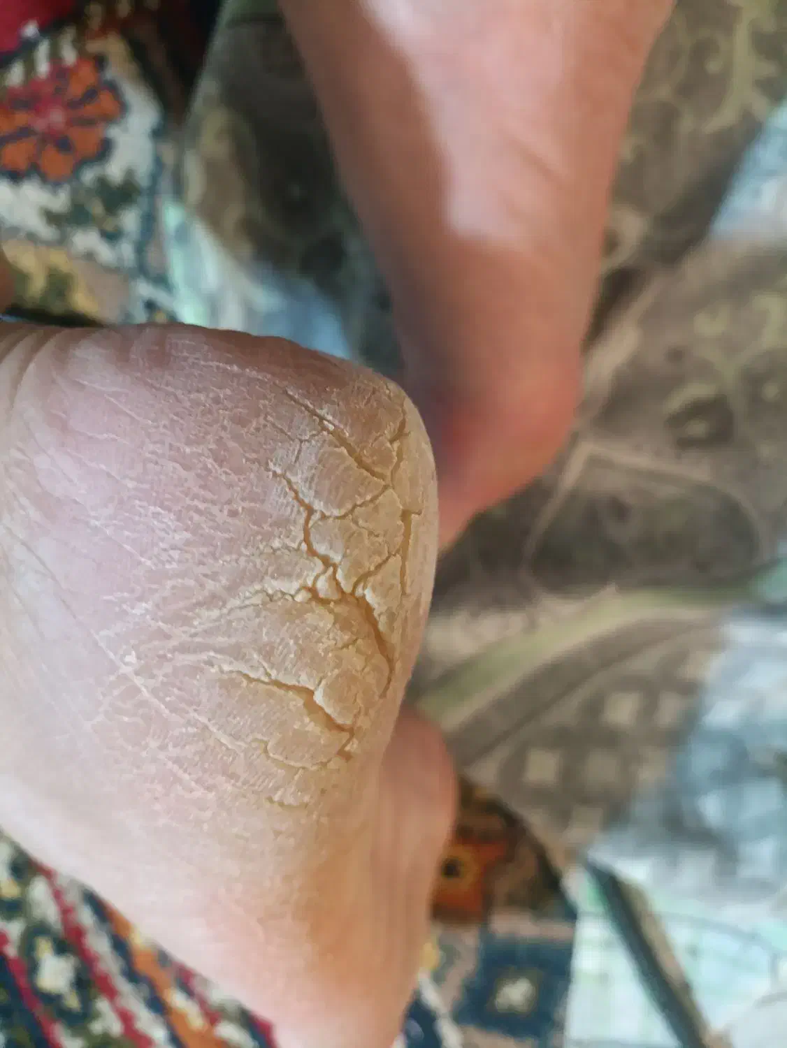 از بین بردن ترک پاشنه پا در یک جلسه  تضمینی|خدمات آرایشگری و زیبایی|شیراز, ماه فیروزان|دیوار