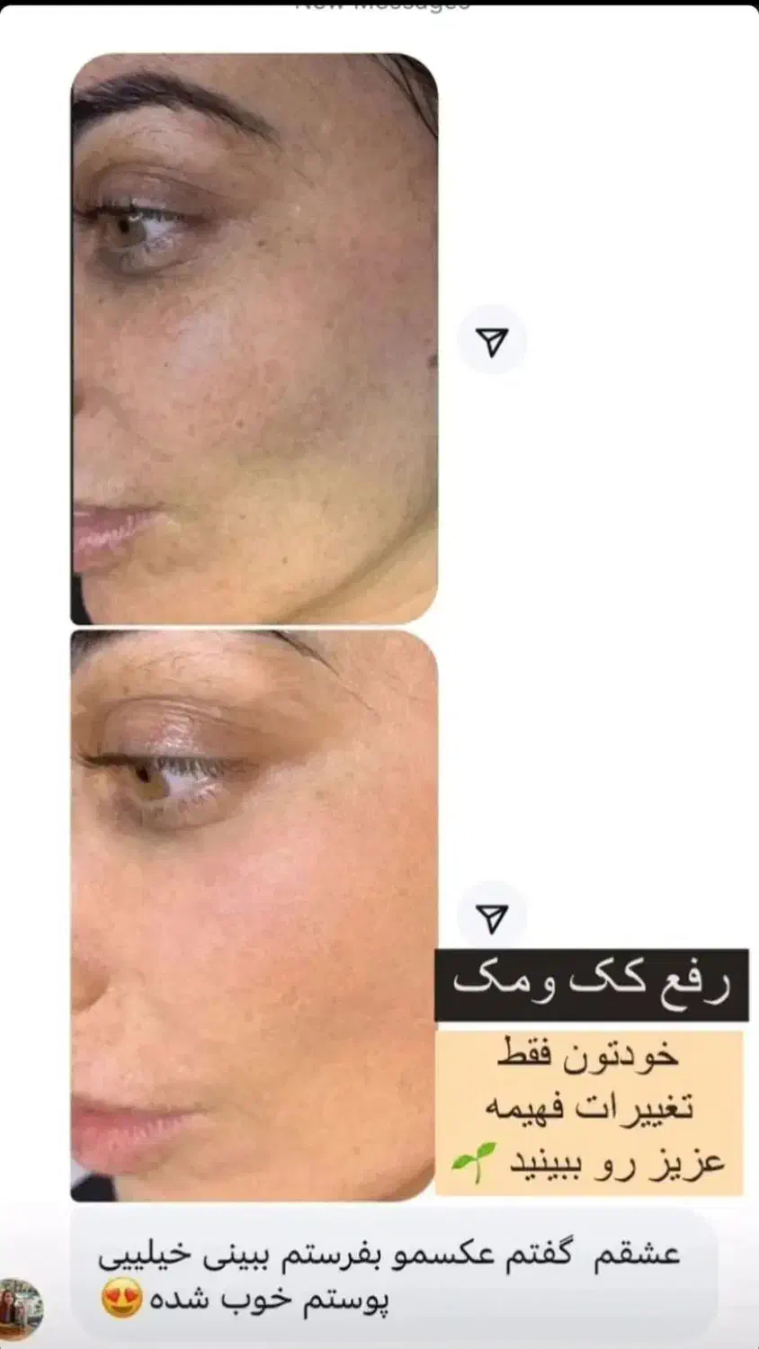 پک صورت گیاهی ضدلک و کک مک|آرایشی، بهداشتی، درمانی|آباده, |دیوار