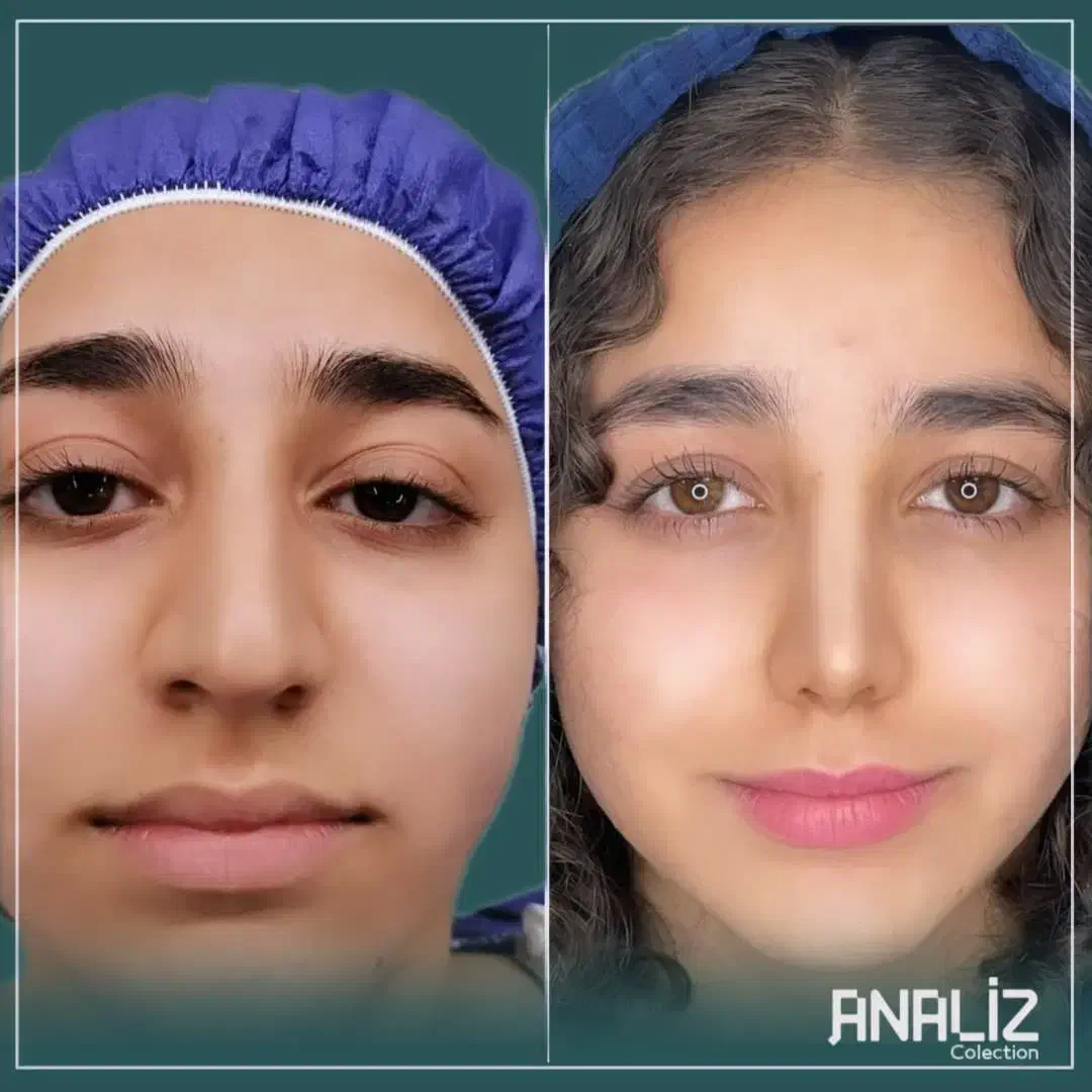 عمل بینی/پلک/غبغب/بوتاکس/پیکرتراشی|خدمات آرایشگری و زیبایی|یاسوج, |دیوار