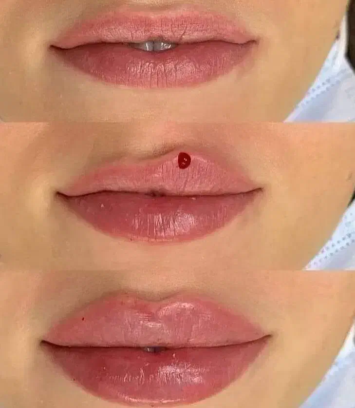 تزریق ژل و بوتاکس|خدمات آرایشگری و زیبایی|کرج, گلشهر|دیوار